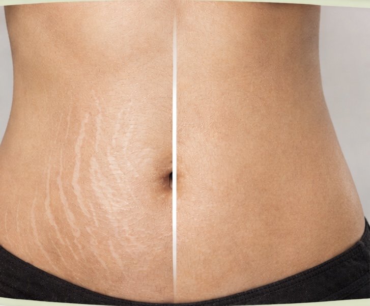 Stretch Marks Treatment